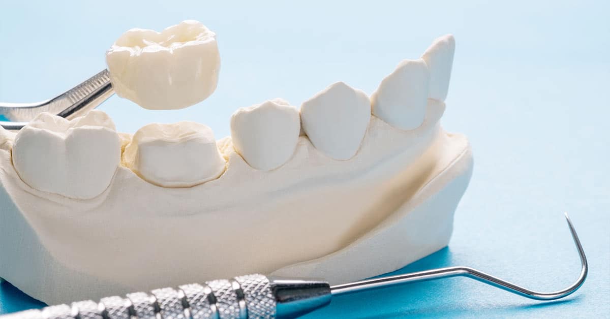 What Is a Dental Crown