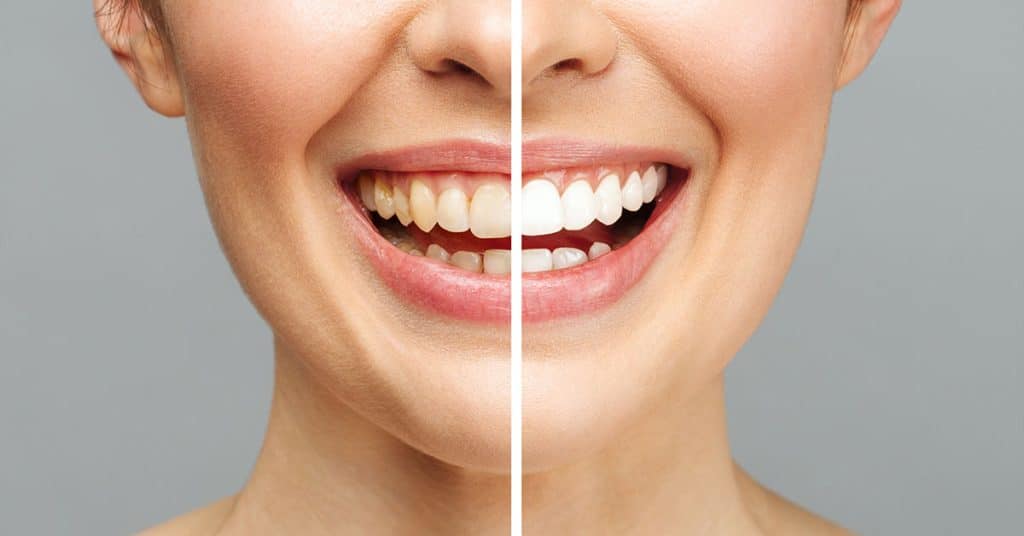 How Long Does Teeth Whitening Take