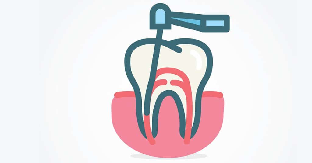 What is Root Canal Therapy